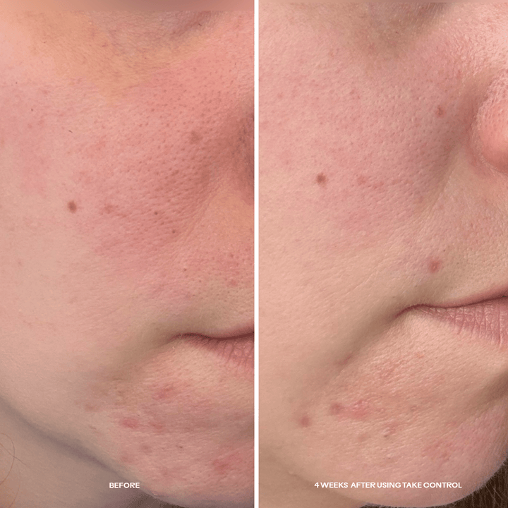 Take Control™ Salicylic + 10% Azelaic Acid Clarifying Serum - Echo Market